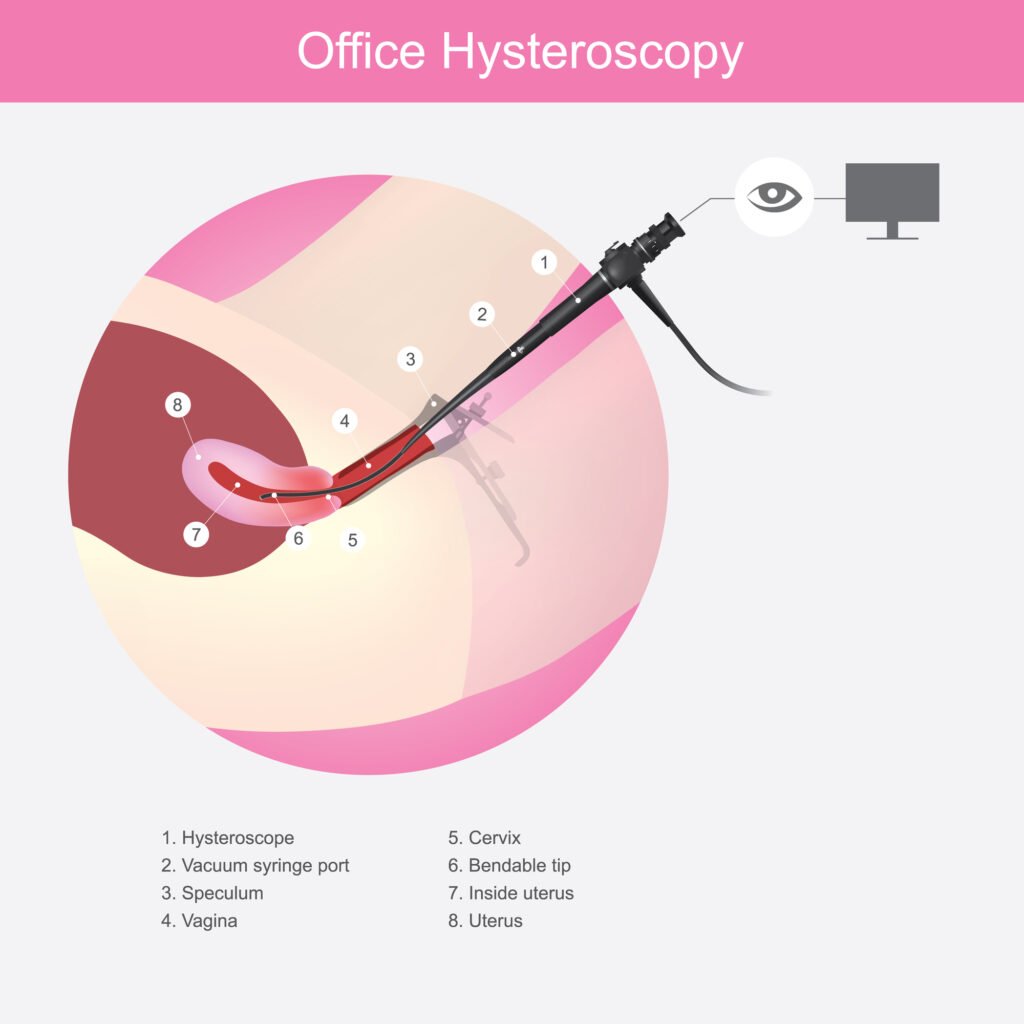 histeroskopi endometrium biyopsisi nedir nasıl yapılır op dr olcay ilhan bursa
